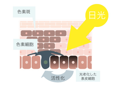 日光黒子の機序:港区でシミ治療なら美容外科・美容皮膚科 青い鳥