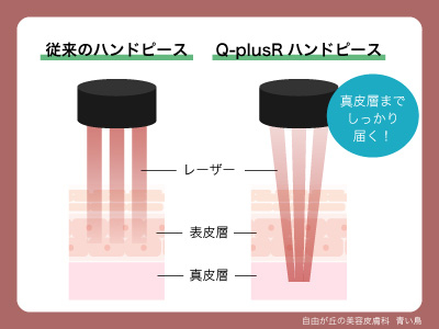 レーザービームの収束:港区でフラクショナルルビーレーザーを受けるなら美容外科・美容皮膚科 青い鳥