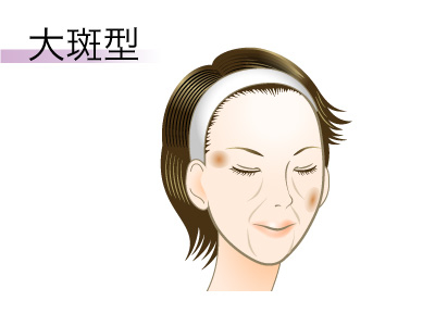 港区でシミ治療なら美容外科・美容皮膚科 青い鳥