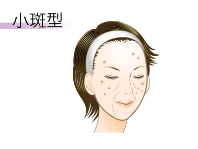 港区でシミ治療なら美容外科・美容皮膚科 青い鳥