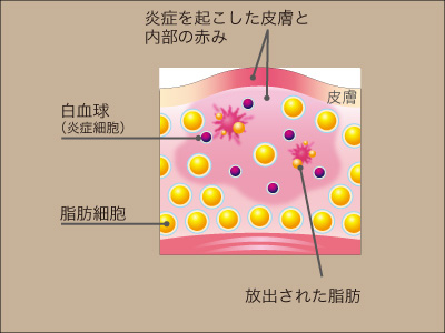 脂肪溶解注射作用機序 1:港区でBNLSファットバーンなら美容外科・美容皮膚科 青い鳥