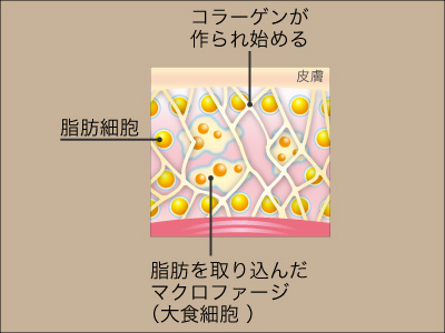 脂肪溶解注射作用機序 3:港区でBNLSファットバーンなら美容外科・美容皮膚科 青い鳥