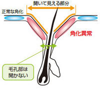 開いた毛穴