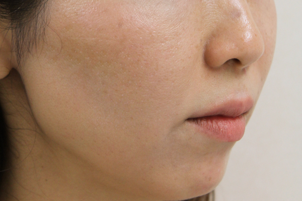 2ヶ月後:港区でサーマクールを受けるなら美容外科・美容皮膚科 青い鳥