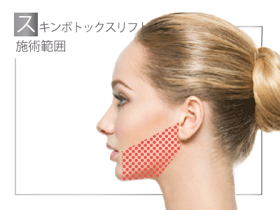 注入範囲:港区でスキンボトックスなら美容外科・美容皮膚科 青い鳥