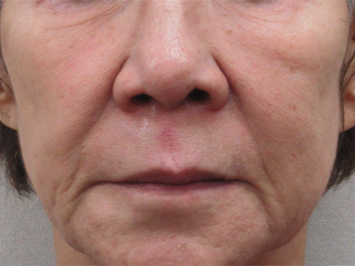 施術2回1か月後:港区でダーマペンなら美容外科・美容皮膚科 青い鳥