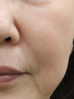 4回施術後：港区でマッサージピールなら美容外科・美容皮膚科 青い鳥