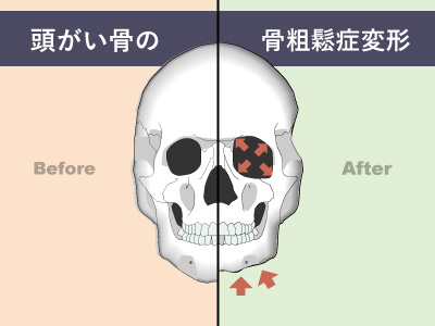 頭蓋骨の骨粗鬆症