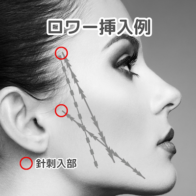ロワー挿入例：港区でクロッキーリフトを受けられるクリニックをお探しなら美容外科・美容皮膚科 青い鳥