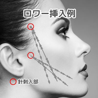 ロワー挿入例：港区でクロッキーリフトを受けられるクリニックをお探しなら美容外科・美容皮膚科 青い鳥