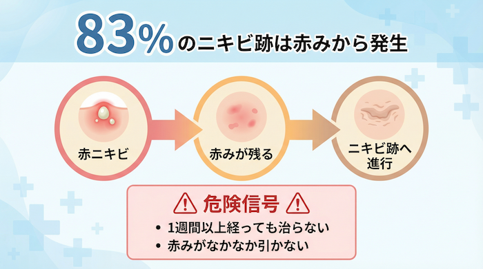 ニキビ跡の8割は赤みから