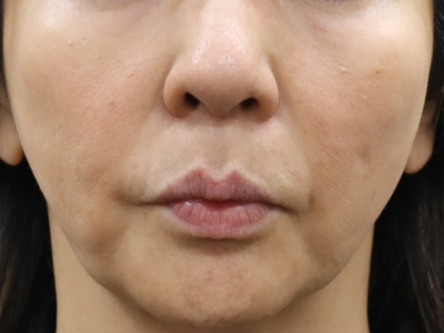 施術1か月後：港区で糸リフトなら美容外科・美容皮膚科 青い鳥