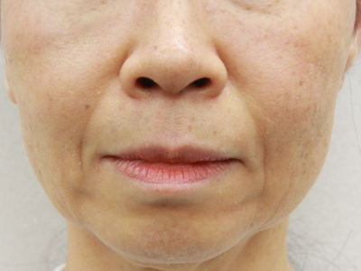 施術1ヶ月後:港区でスキャフォールドを受けるなら美容外科・美容皮膚科 青い鳥