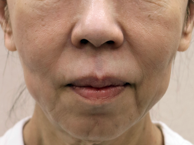 2回施術後2か月後：港区でジャルプロスーパーハイドロを受けるなら美容外科・美容皮膚科 青い鳥