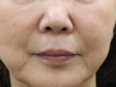 4回治療後:港区でマッサージピールなら美容外科・美容皮膚科 青い鳥