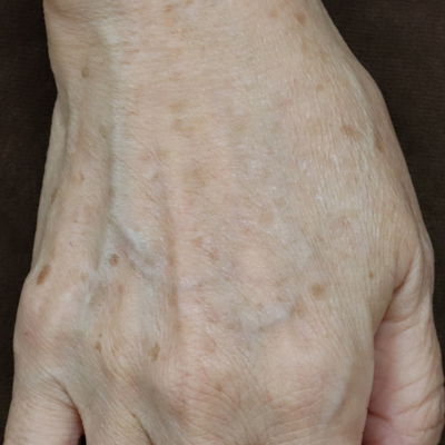 治療前:港区でジャルプロを受けるなら美容外科・美容皮膚科 青い鳥