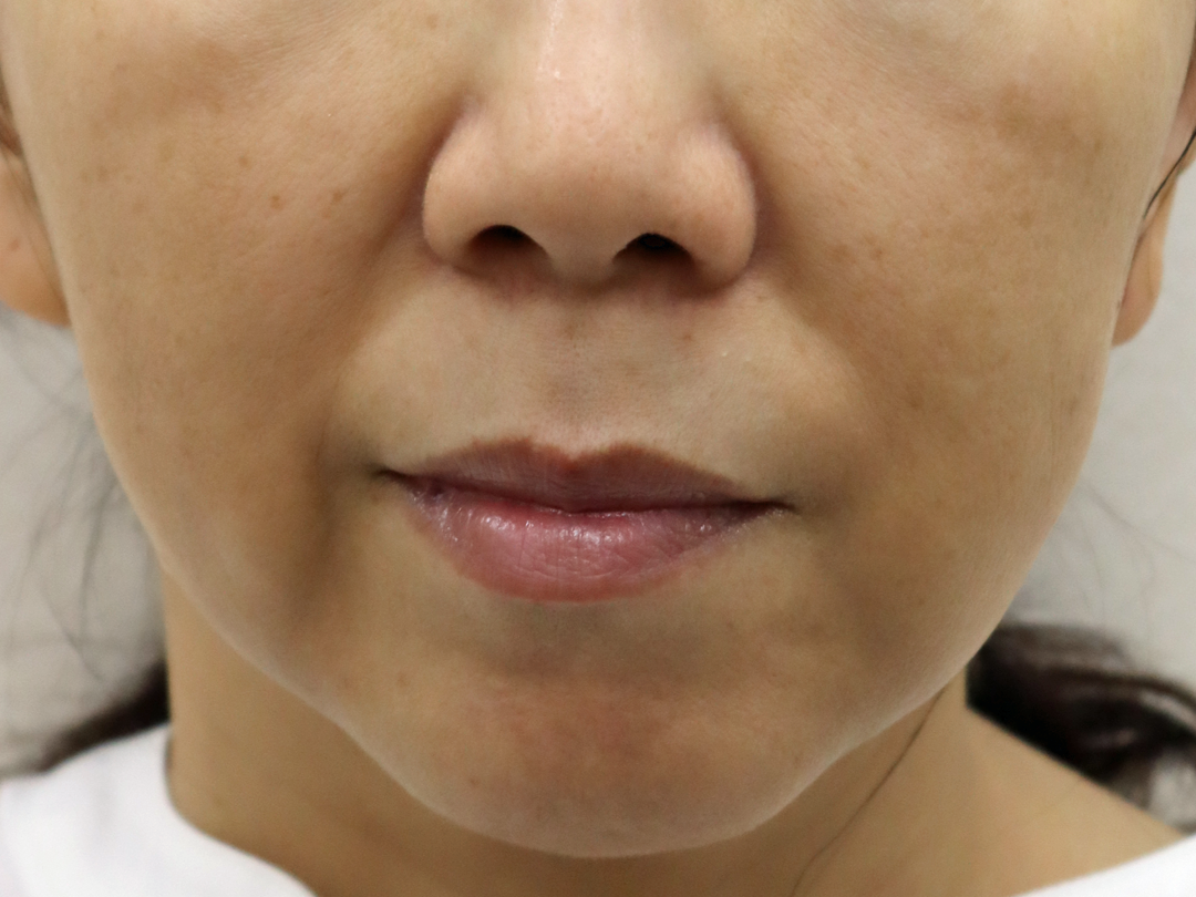 施術後1ヶ月:港区でスキャフォールドを受けるなら美容外科・美容皮膚科 青い鳥