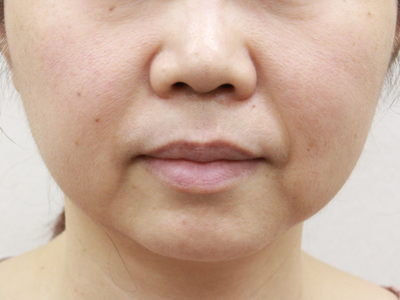 2ヶ月後：港区でハイフを受けるなら美容外科・美容皮膚科 青い鳥