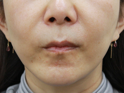 施術1ヶ月後：港区でアルテミスリフトを受けるなら美容外科・美容皮膚科 青い鳥