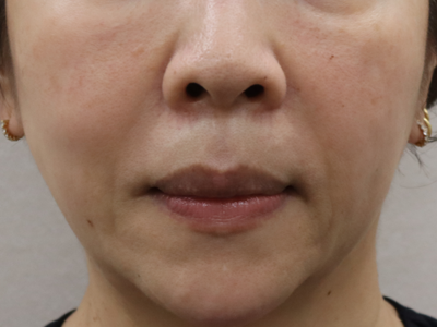 施術1か月後:港区でクロッキーリフトを受けるなら美容外科・美容皮膚科 青い鳥