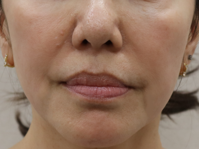 施術1か月後:港区で糸リフトなら美容外科・美容皮膚科 青い鳥