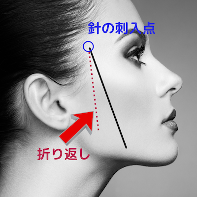 アルテミスリフトの「折り返し」