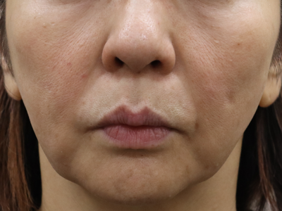 施術前:港区で糸リフトなら美容外科・美容皮膚科 青い鳥