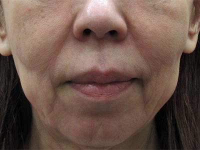 施術前:港区でジャルプロスーパーハイドロを受けるなら美容外科・美容皮膚科 青い鳥