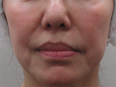 施術前:港区で糸リフトなら美容外科・美容皮膚科 青い鳥