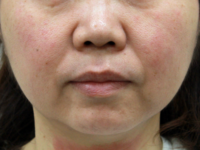 施術前：港区でハイフを受けるなら美容外科・美容皮膚科 青い鳥
