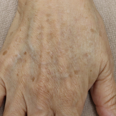 治療前:港区でジャルプロを受けるなら美容外科・美容皮膚科 青い鳥