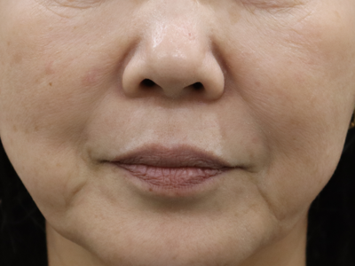 治療前:港区でマッサージピールなら美容外科・美容皮膚科 青い鳥