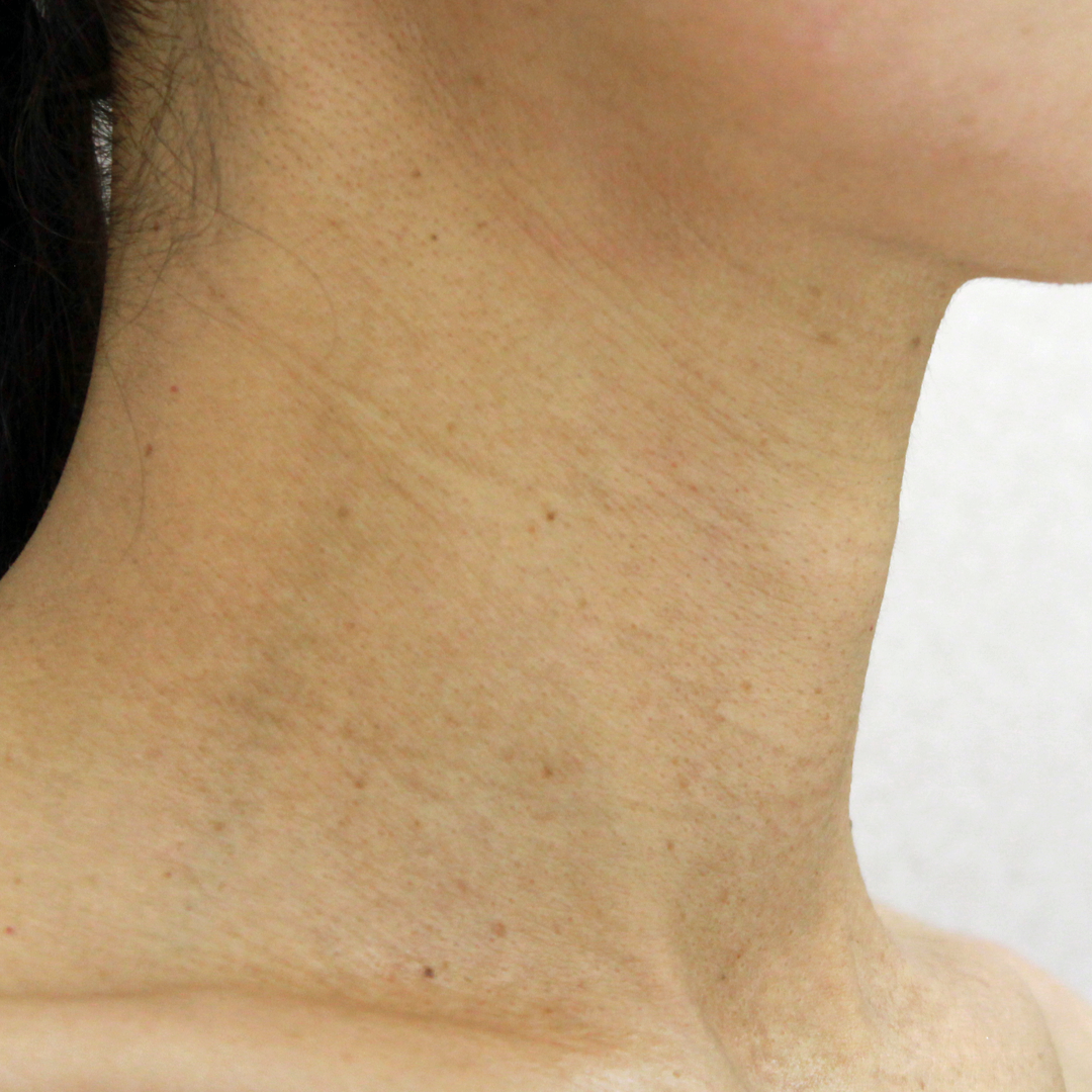 施術前:港区でハイドロの施術を受けるなら美容外科・美容皮膚科 青い鳥