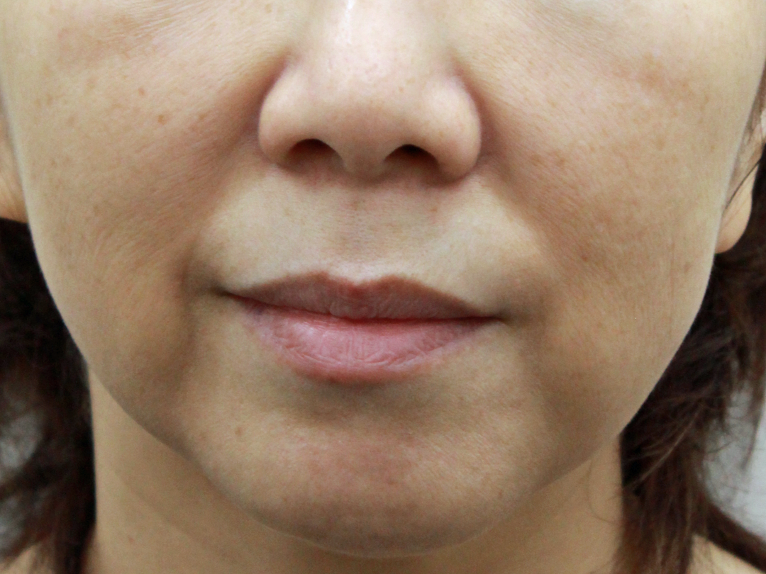 術前:港区でスキャフォールドを受けるなら美容外科・美容皮膚科 青い鳥