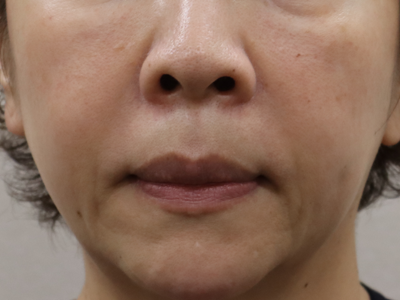 施術前:港区でクロッキーリフトを受けるなら美容外科・美容皮膚科 青い鳥