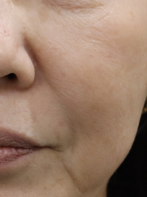 施術前：港区でマッサージピールなら美容外科・美容皮膚科 青い鳥