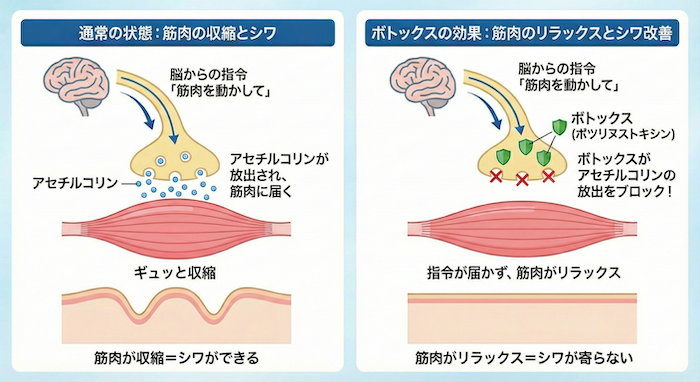港区】ボトックス注射（ボツリヌス療法）｜シワ取り・エラ・小顔治療の