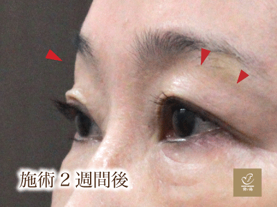 施術2週後