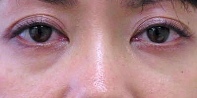 目の下の「くま」前:港区でヒアルロン酸注入を受けるなら美容外科・美容皮膚科 青い鳥