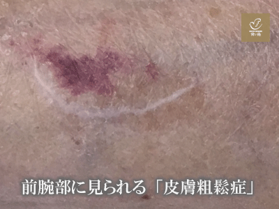 皮膚粗鬆症