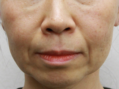 2ヶ月後：港区でハイフを受けるなら美容外科・美容皮膚科 青い鳥