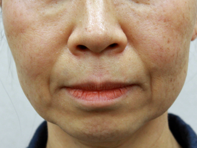 施術前：港区でハイフを受けるなら美容外科・美容皮膚科 青い鳥