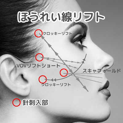 ほうれい線リフトなら港区浜松町の美容外科・美容皮膚科 青い鳥