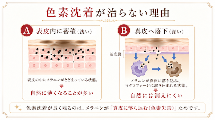 色素失禁