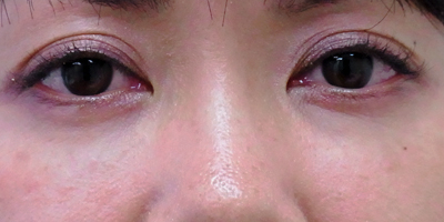 目の下の「くま」後:港区でヒアルロン酸注入を受けるなら美容外科・美容皮膚科 青い鳥