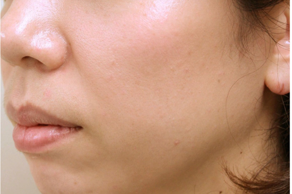 施術（70本）1ヶ月後:港区でショッピングスレッドを受けるなら美容外科・美容皮膚科 青い鳥