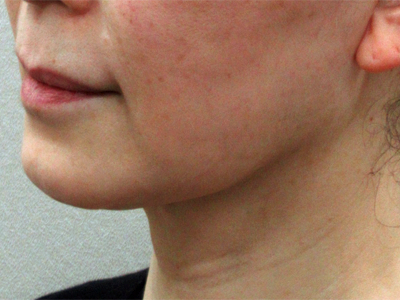 施術1か月後：港区でネフェルティティリフトを受けるなら美容外科・美容皮膚科 青い鳥