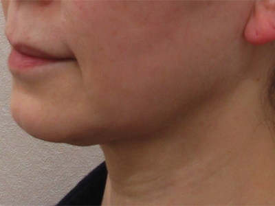 施術前：港区でネフェルティティリフトを受けるなら美容外科・美容皮膚科 青い鳥