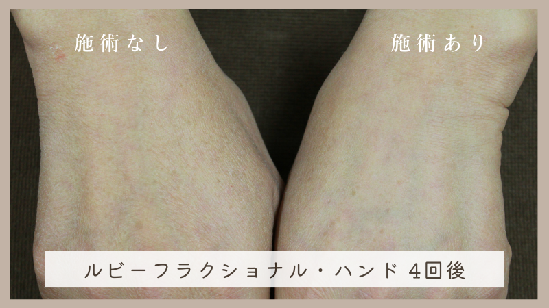 港区でルビーフラクショナルを受けるなら美容外科・美容皮膚科 青い鳥