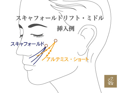 ミドル・糸の挿入例:港区でスキャフォールドを受けるなら美容外科・美容皮膚科 青い鳥